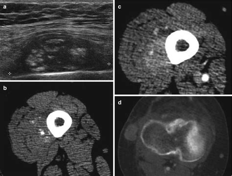 what is the best test to see soft tissue metastasis|Tests for Soft Tissue Sarcomas .